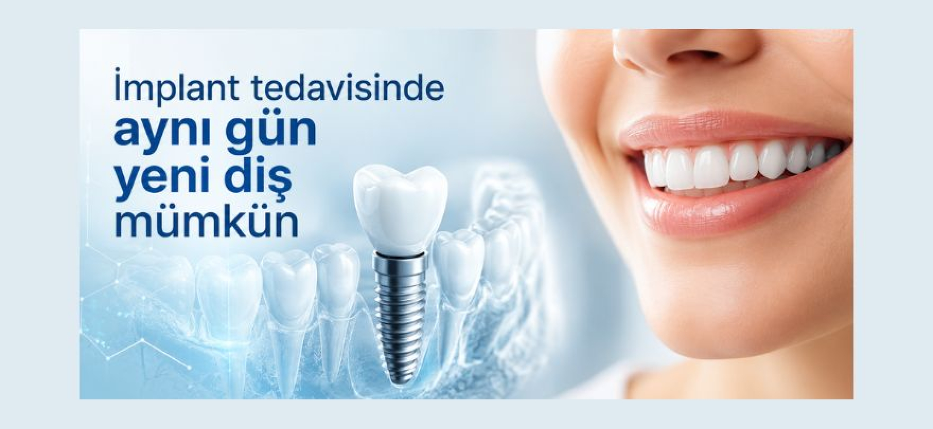 İmplant tedavisinde Aynı Gün Yeni Diş Mümkün implant tedavisi, diş implantı, dijital diş hekimliği, implant cerrahisi, ağız ve diş sağlığı